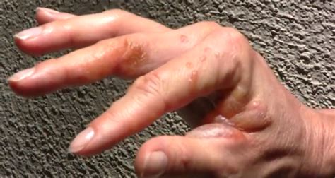 Poison Ivy Rash Pictures Symptoms Causes Treatment Hubpages