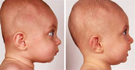 Flat Head Syndrome Flat Head In Newborn Babies Marham