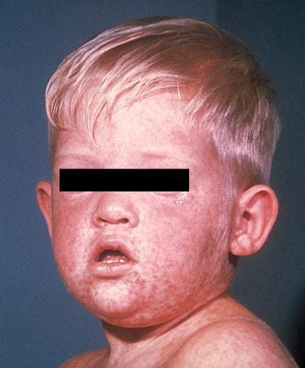 Measles For Healthcare Professionals Cdc