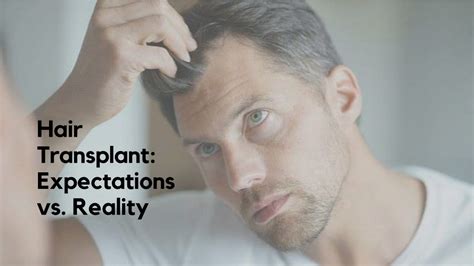 PPT Hair Transplant Expectations Vs Reality PowerPoint Presentation