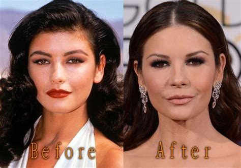 Catherine Zeta Jones Plastic Surgery Before After Celebrity Surgery Plastic Surgery