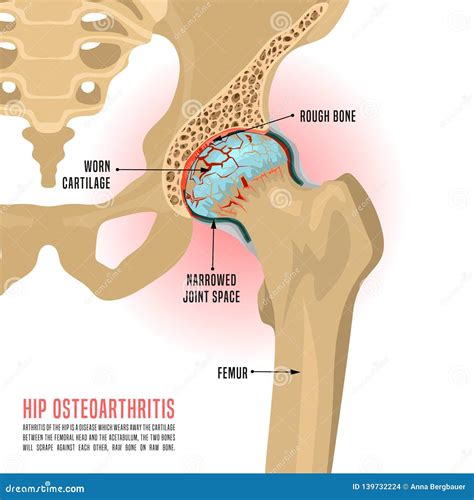 Hip Osteoarthritis Infographic Vector Illustration