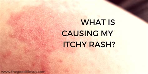 What Is Causing My Itchy Rash Thegoodlife4us Itchy Rash Rashes