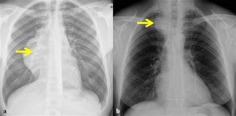 Mediastinal Signs Frontal Chest Film A Shows The Hilum Arrow