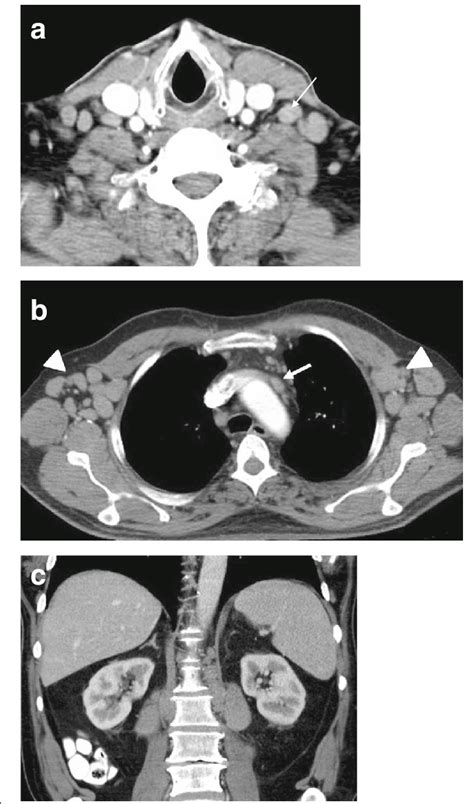 69 Year Old Woman At The Time Of Diagnosis With Cll A Axial Ct Image