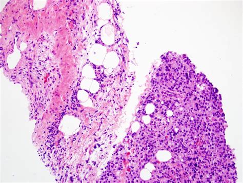 Pathology Outlines Biopsy