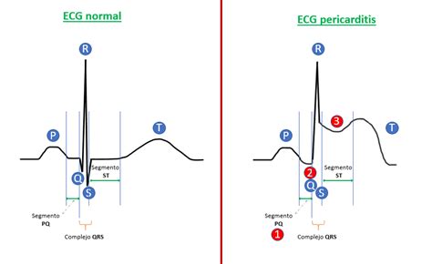 Cómo identificar pericarditis en un ECG Guía sencilla