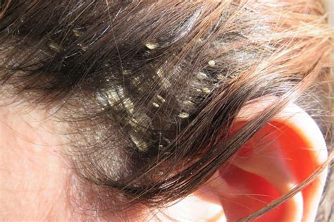 Dandruff What Is It And How Can You Treat It Mediceuticals