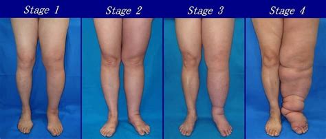 Lymphedema Condition Overview [causes Stages Symptoms Treatments Precautions] Lymphedema