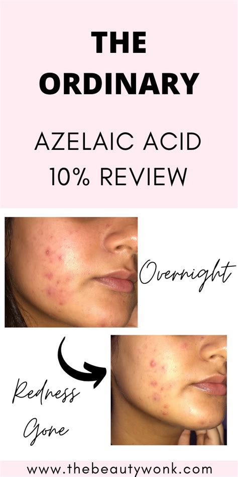 The Ordinary Azelaic Acid Suspension 10 Review The Beauty Wonk The
