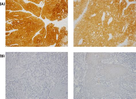 P16 Staining Of Thai Oropharyngeal Squamous Cell Carcinoma Samples At