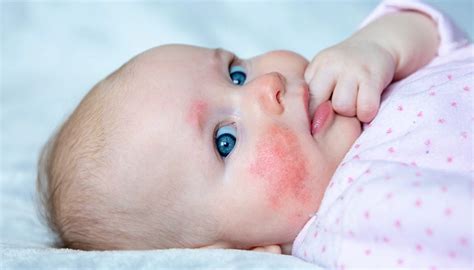 Understanding And Caring For Your Newborns Skin Common Ailments To