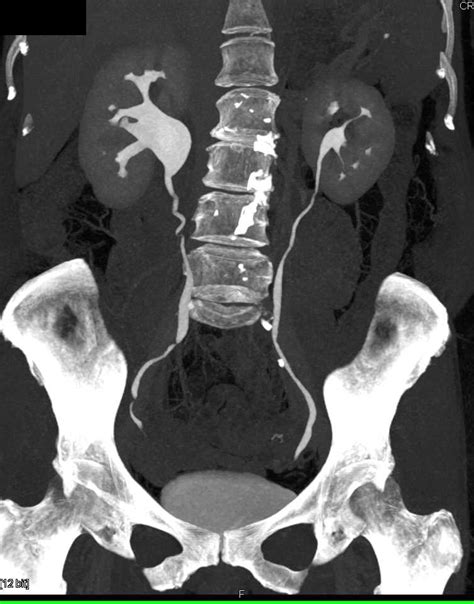 Upj With Dilated Right Renal Pelvis Kidney Case Studies Ctisus Ct