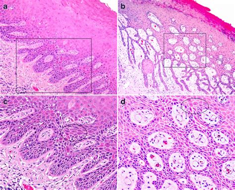 Example Of Differentiated Vin With Characteristic Features He Stain