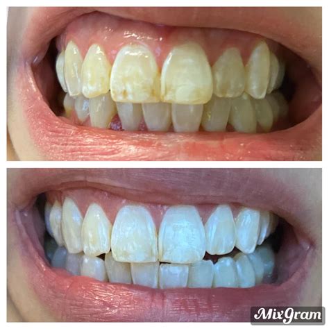 F3557 200lbs 200lbs 0lbs White Strips Flossing 2x A Day