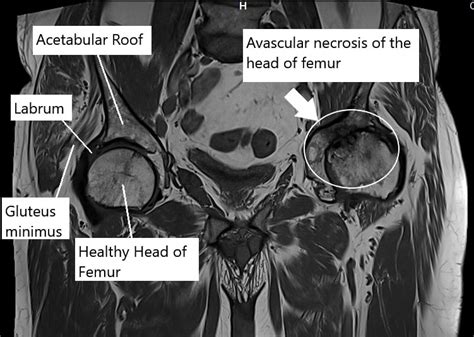 Hip Avascular Necrosis Osteonecrosis In Nyc Complete Orthopedics