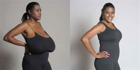 Gigantomastia Womans Breasts Grow To 36nnn