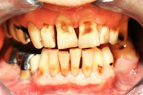 What To Do When Your Teeth Start Falling Out News Dentagama