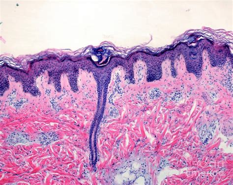 Fibroma Of The Skin Photograph By Jose Calvoscience Photo Library