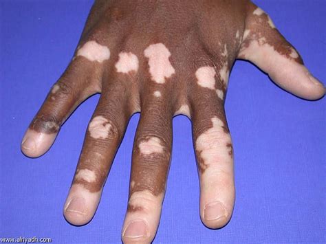 What Is Vitiligo ‏what Causes Vitiligo Health Fitness