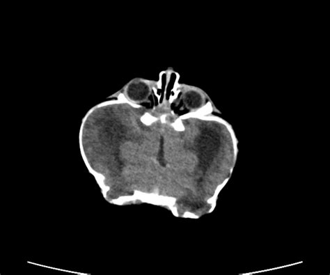 Cloverleaf Skull Deformity Image