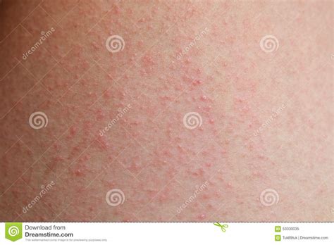 Allergic Rash Dermatitis Skin Stock Image Image Of People Pain 53330035