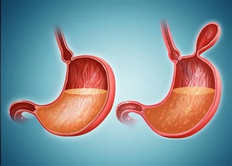 Stomach With And Without Hernia Photograph By Pixologicstudio Fine