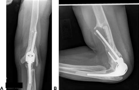 Results Of Total Elbow Arthroplasty In Patients Less Than 50 Years Old