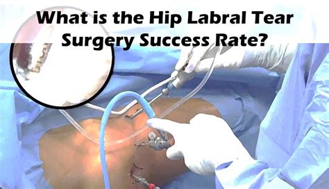 Hip Labral Tear Surgery Success Rate