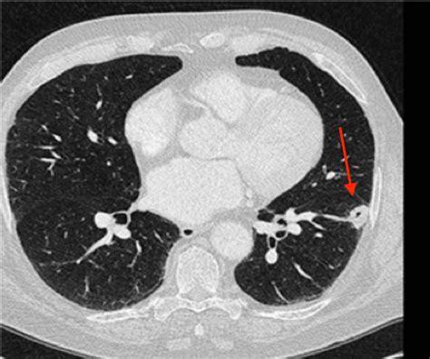 Cureus Spontaneous Regression Of Non Small Cell Lung Cancer A Case