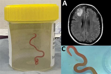 Doctors Remove Live Inch Parasitic Worm From Womans Brain In Worlds