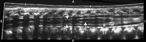 Normal Sagittal Neonatal Spine On An Extended Field Of View Ultrasound