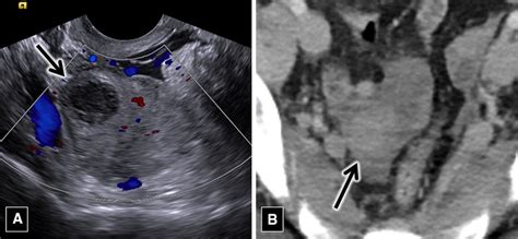 Year Old Woman With Ovarian Torsion A Color Doppler Ultrasound