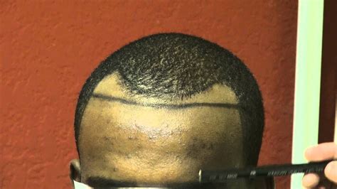 If you have thinning hair. Black Male Bay Area Bald CA Hair Loss Receding Hairline ...