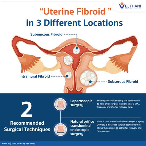 The Difference Of Uterine Fibroid In 3 Different Locations Vejthani Hospital Jci Accredited