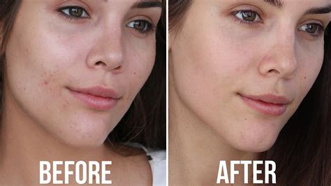 Sensitive Acne Prone Skin Routine Beauty And Health