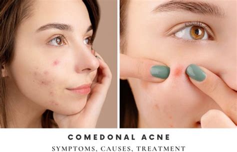 Comedonal Acne Symptoms Causes Treatment And Tips