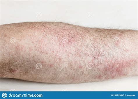 Rash On Outside Forearm Close Up Stock Image Image Of Inflamed
