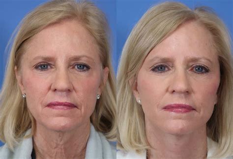 Facelift And Necklift Before And After Savannah Facial Plastic Surgery