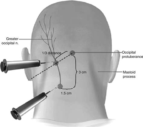 Occipital Neuralgia Nerve Block