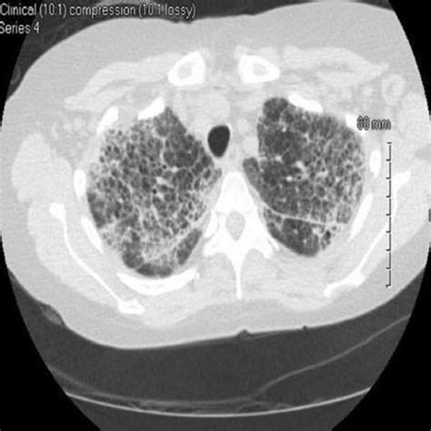 Chest Ct Revealing Diffuse Interstitial Lung Disease With Septal