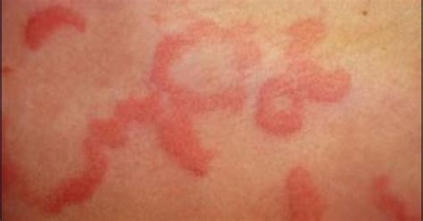 What Could Be Causing Your Hives Itchy Skin Rash Urticaria And