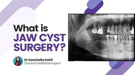 What Is Jaw Cyst Surgery Face Surgery In Delhi Dr Sanchaita Kohli