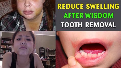 How To Reduce Swelling After Wisdom Tooth Removalhow To Reduce