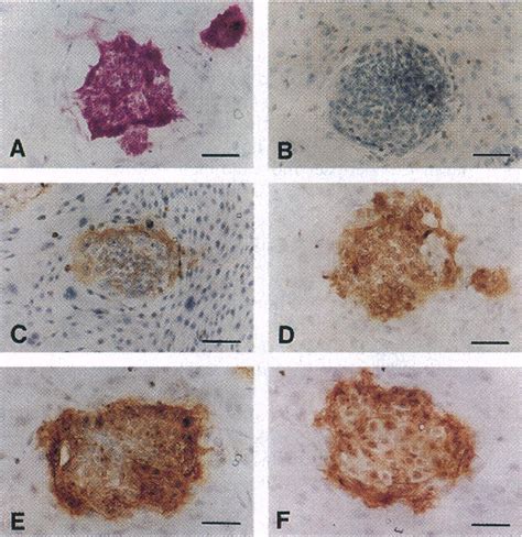 Childhood Central Nervous System Germ Cell Tumor Semantic Scholar