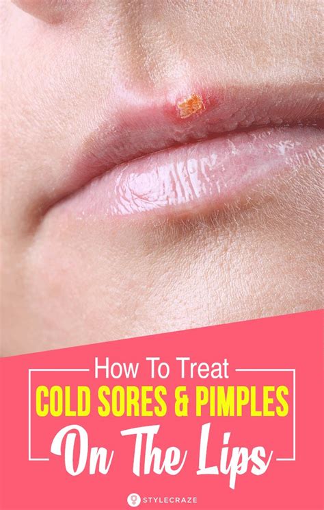 Cold Sores Vs Pimples How They Look Causes And Treatment How To Treat Pimples Pimples Cold