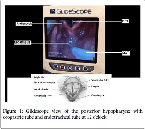 Internal Medicine Orogastric Tube