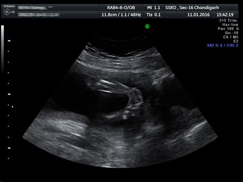 Find the perfect the clubfoot stock photo. SSRD - Interesting Cases - Fetal Clubfoot - Ultrasound ...