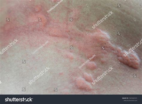 Urticaria On Skin Rashes Which Urticaria Foto Stock 1565360101