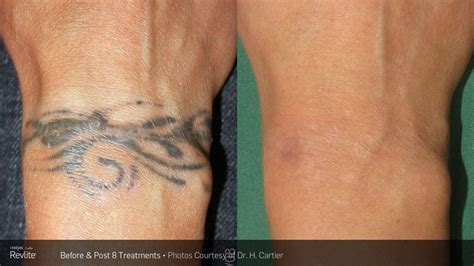 How to remove kids' temporary tattoos or one of those machines at the supermarket that make you spend another £1 when you thought you couldn't spend another penny! Laser Tattoo Removal Detroit | Elite Ink
